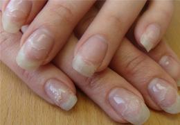 Почему слоятся ногти после гель-лака: причины и способы борьбы